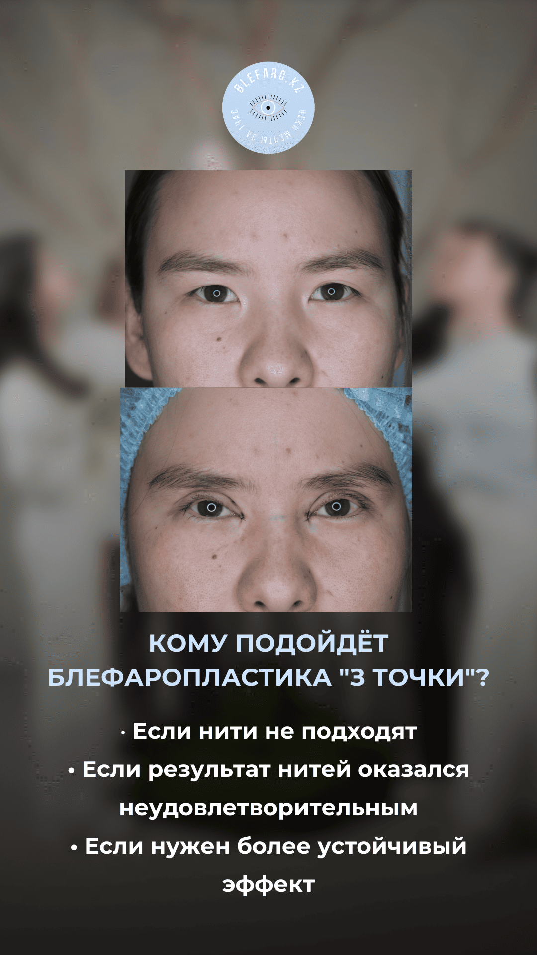 Блефаропластика 3 точки