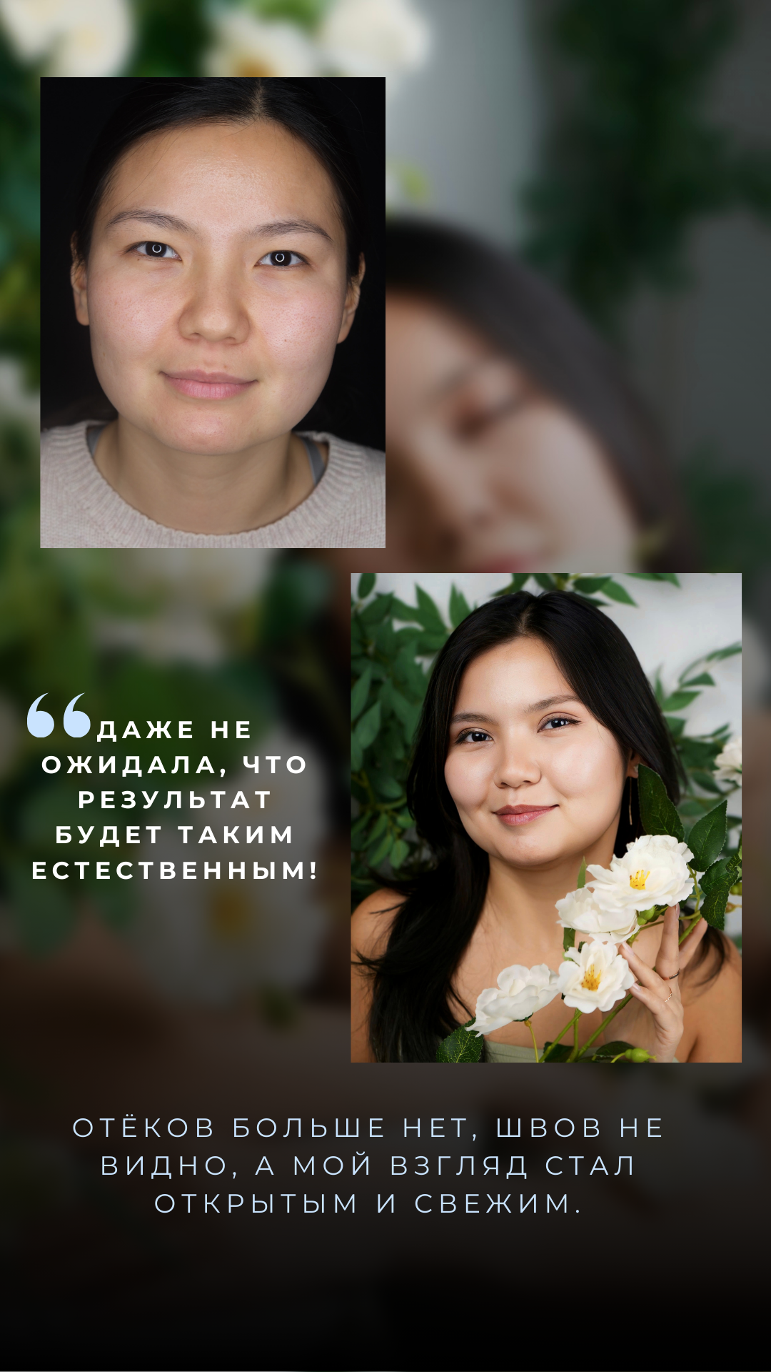 Блефаропластика 3 точки