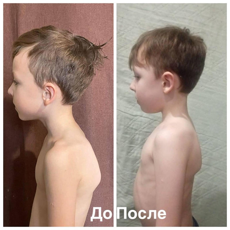 Результат до и после — осанка