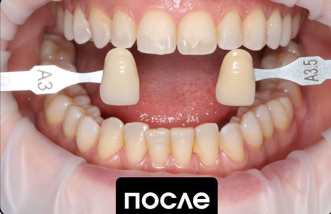 После