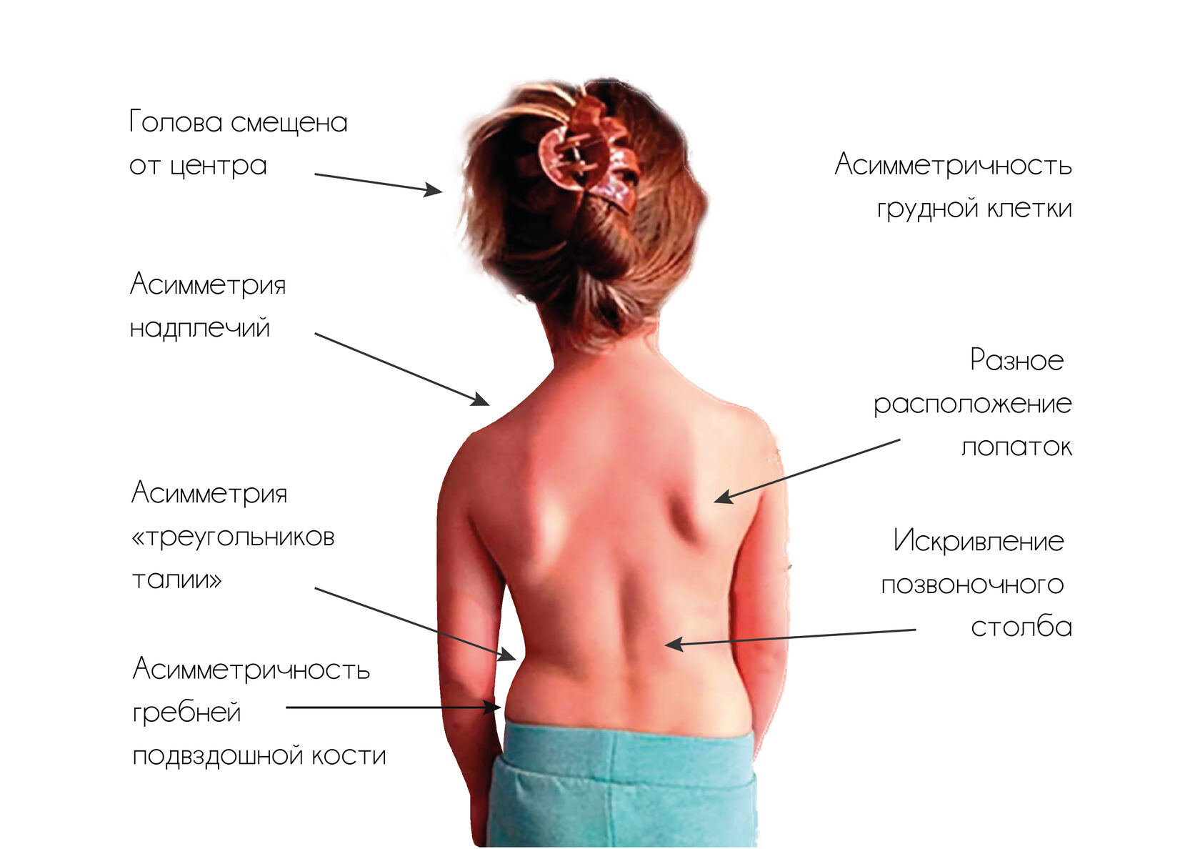 Сколиоз симптомы у подростков. Массаж при сколиозе у подростков. Массаж при сколиозе у детей. Дифференциация позвоночника. ЛФК при сколиозе у детей.