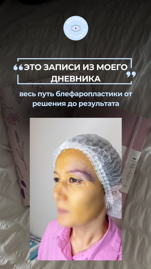 Классическая блефаропластика