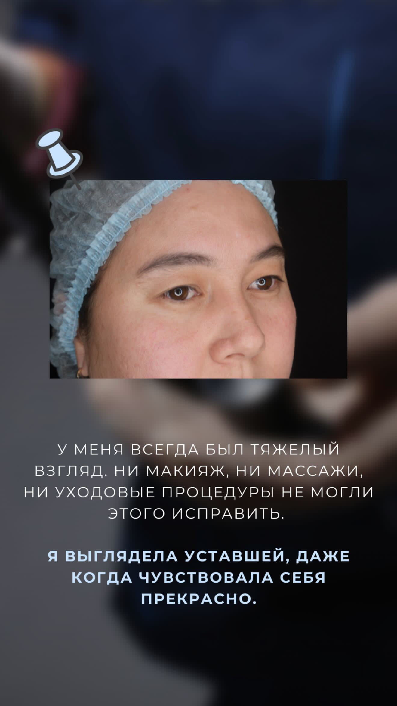 Классическая блефаропластика