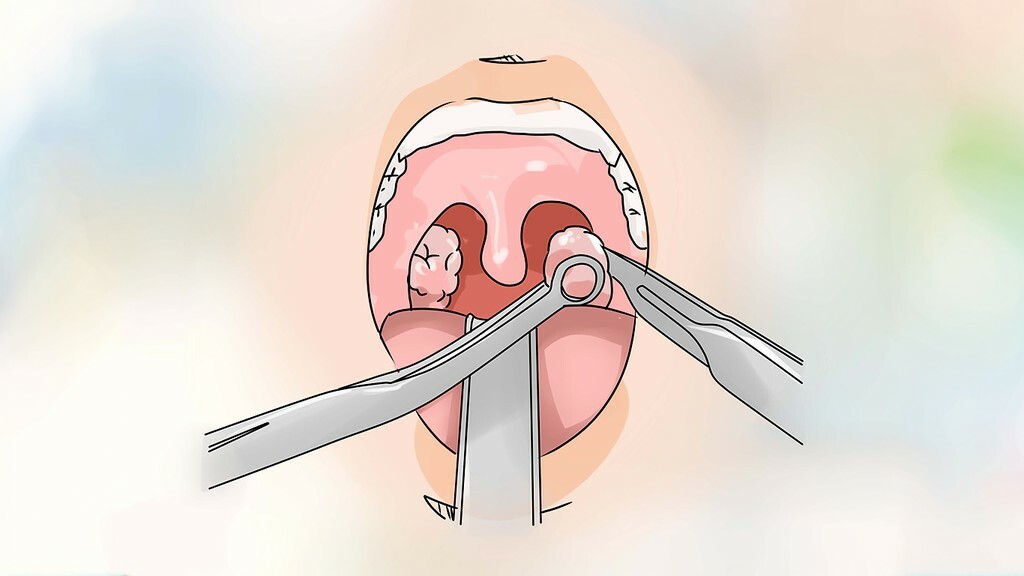 Киста миндалины: лечить или удалять