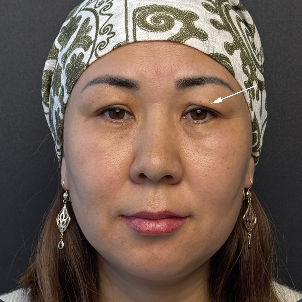 Блефаропластика · До