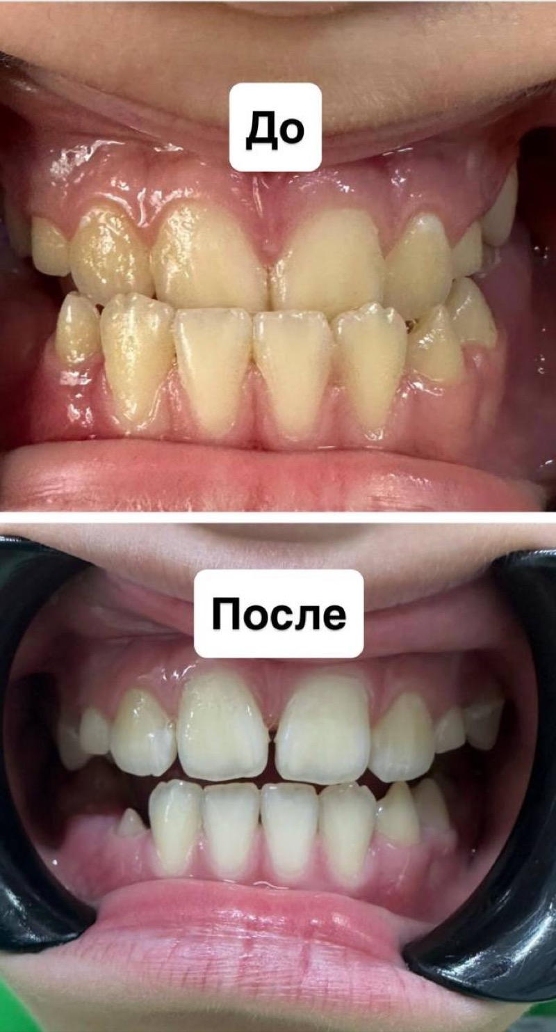 Результат до и после — прикус