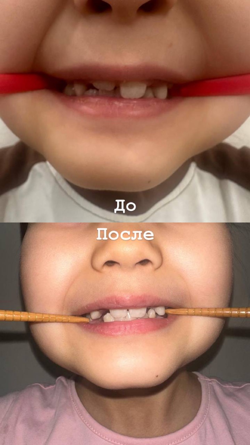 Результат до и после — положение зубов