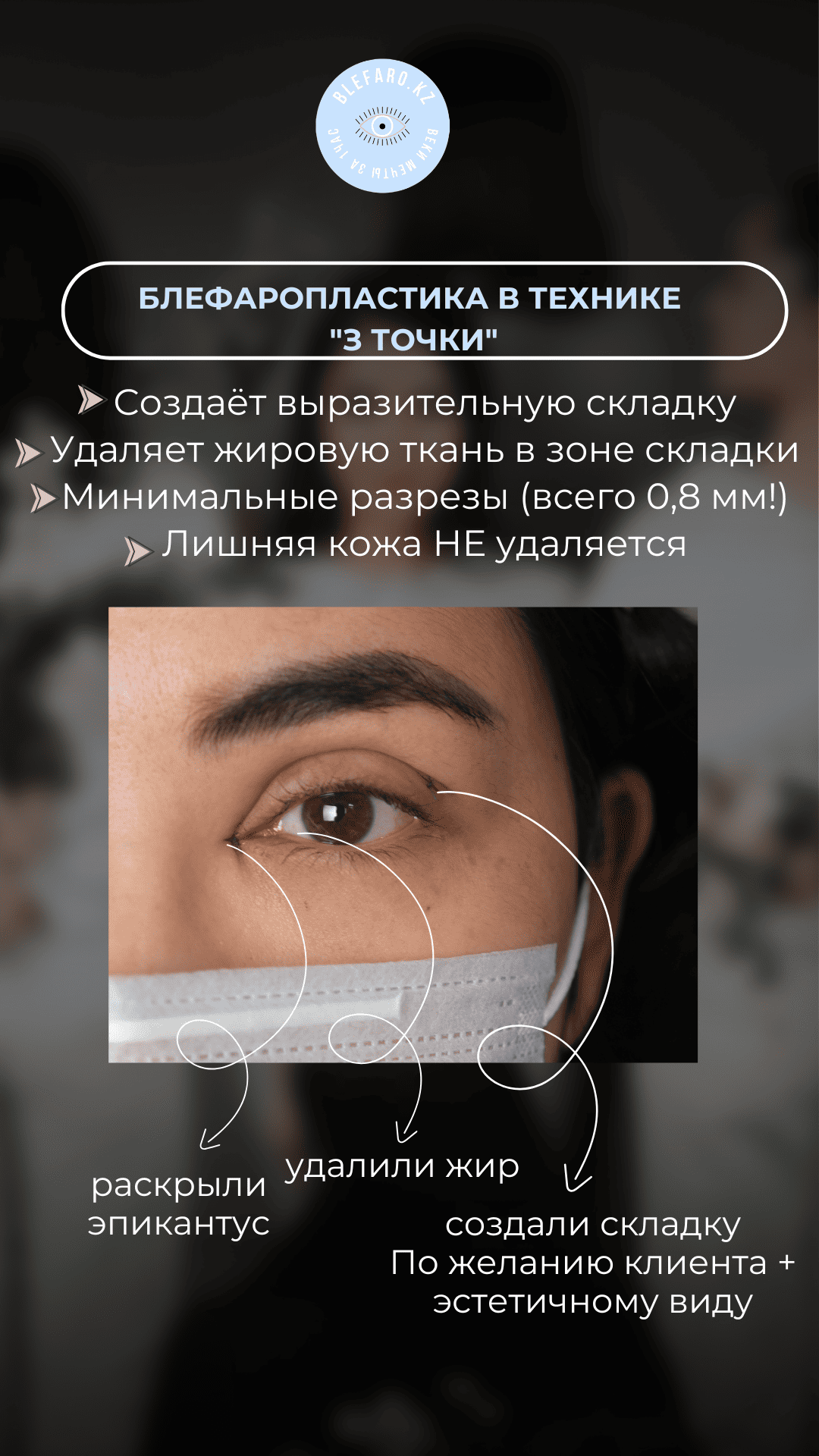 Блефаропластика 3 точки