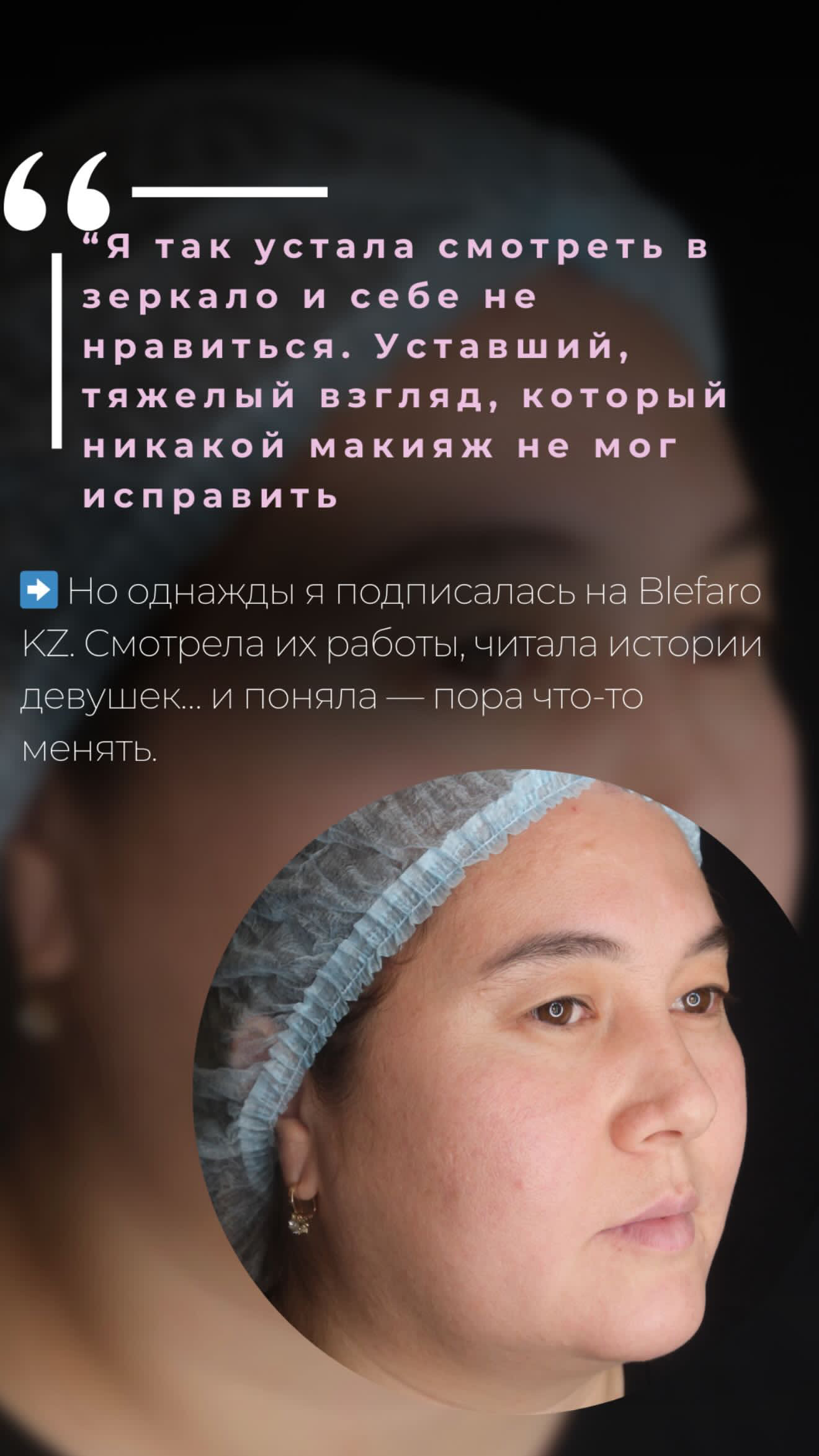 Классическая блефаропластика до и после