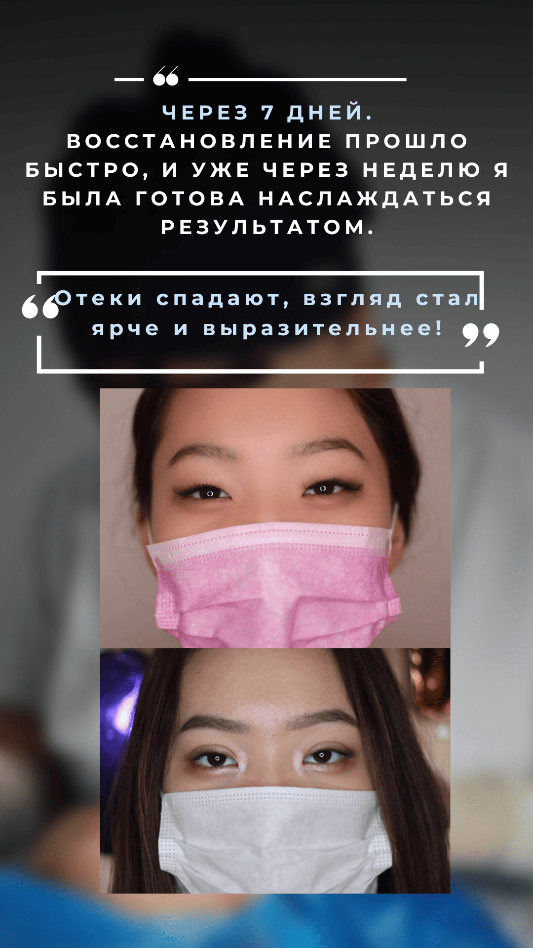 Нитевая блефаропластика