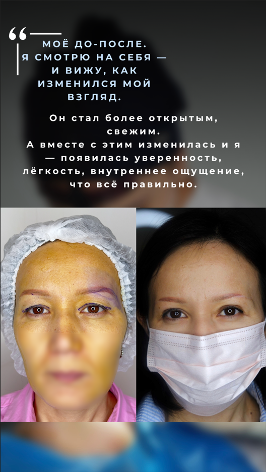 Классическая блефаропластика