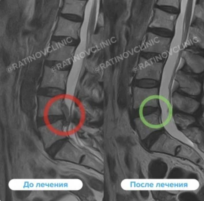МРТ до и после лечения грыжи