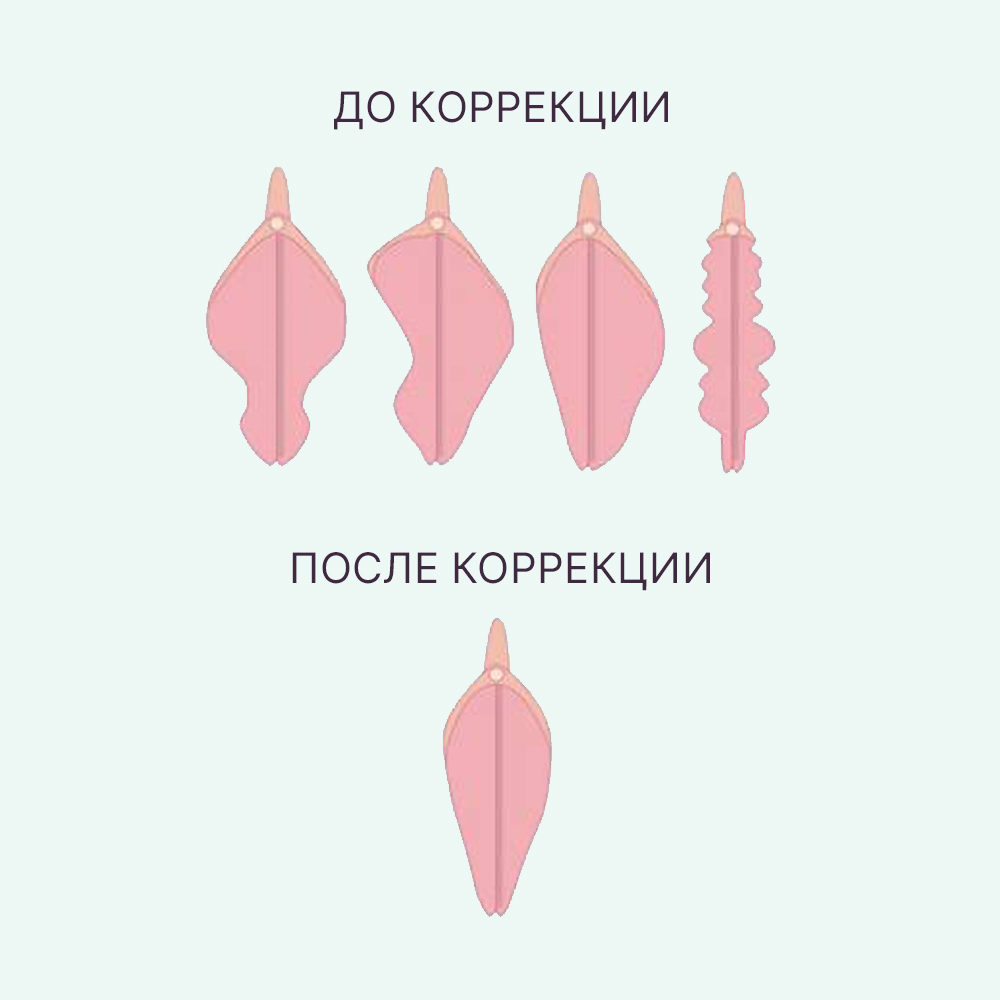 малые половые губы жены Половой псориаз у женщин и мужчин: лечение псориаза на половых органах