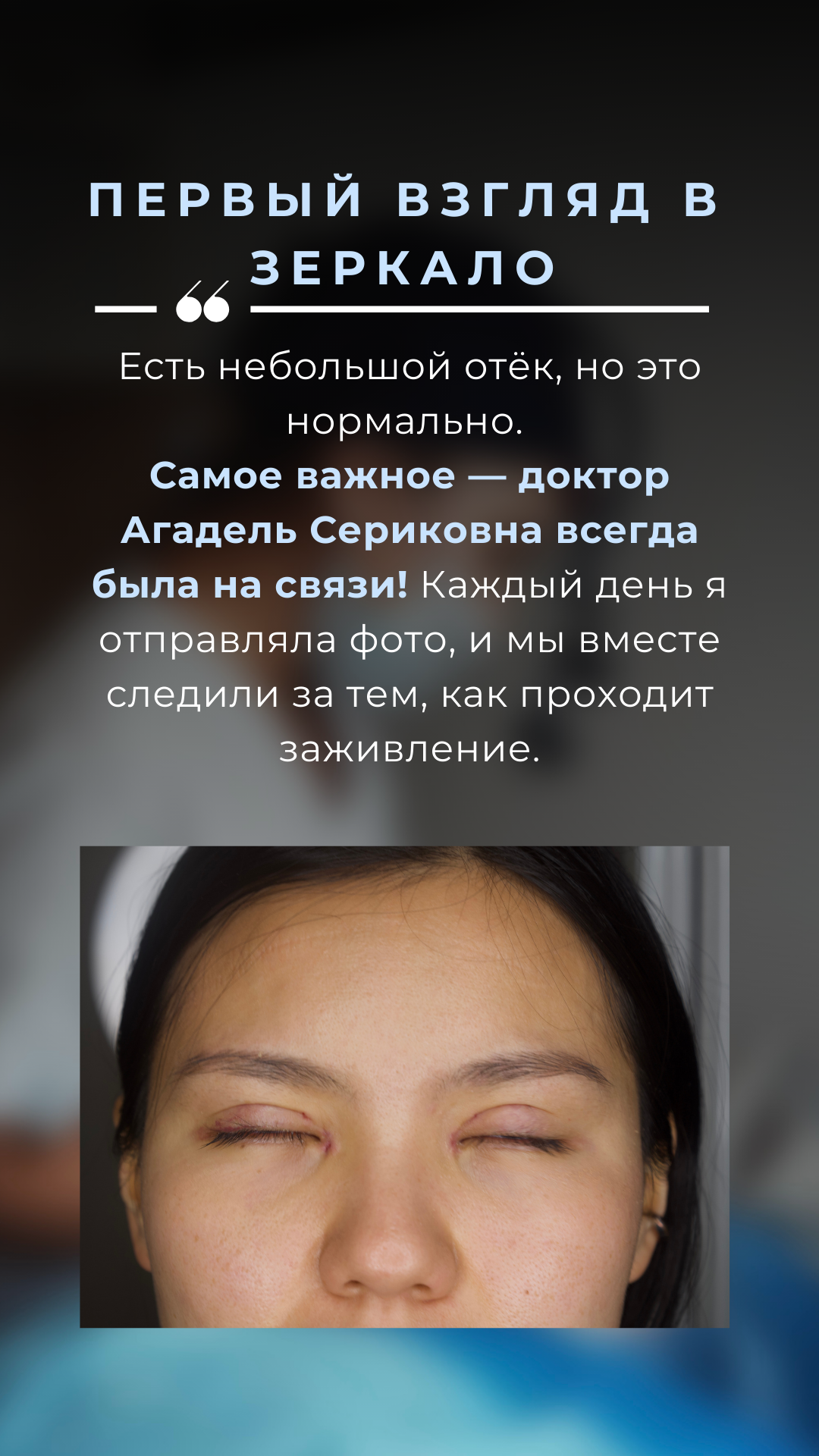 Блефаропластика 3 точки