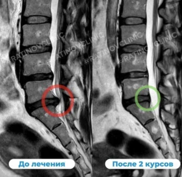 МРТ до и после лечения грыжи