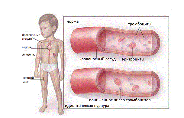 Сколько стоит лечить идиопатическую тромбоцитопеническую пурпуру