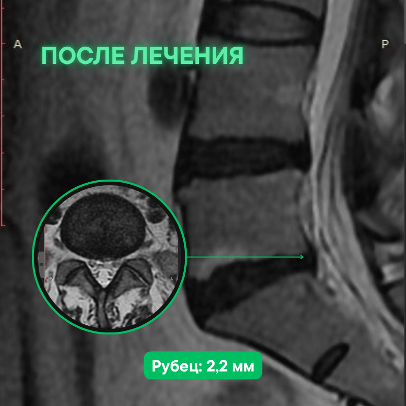 МРТ после