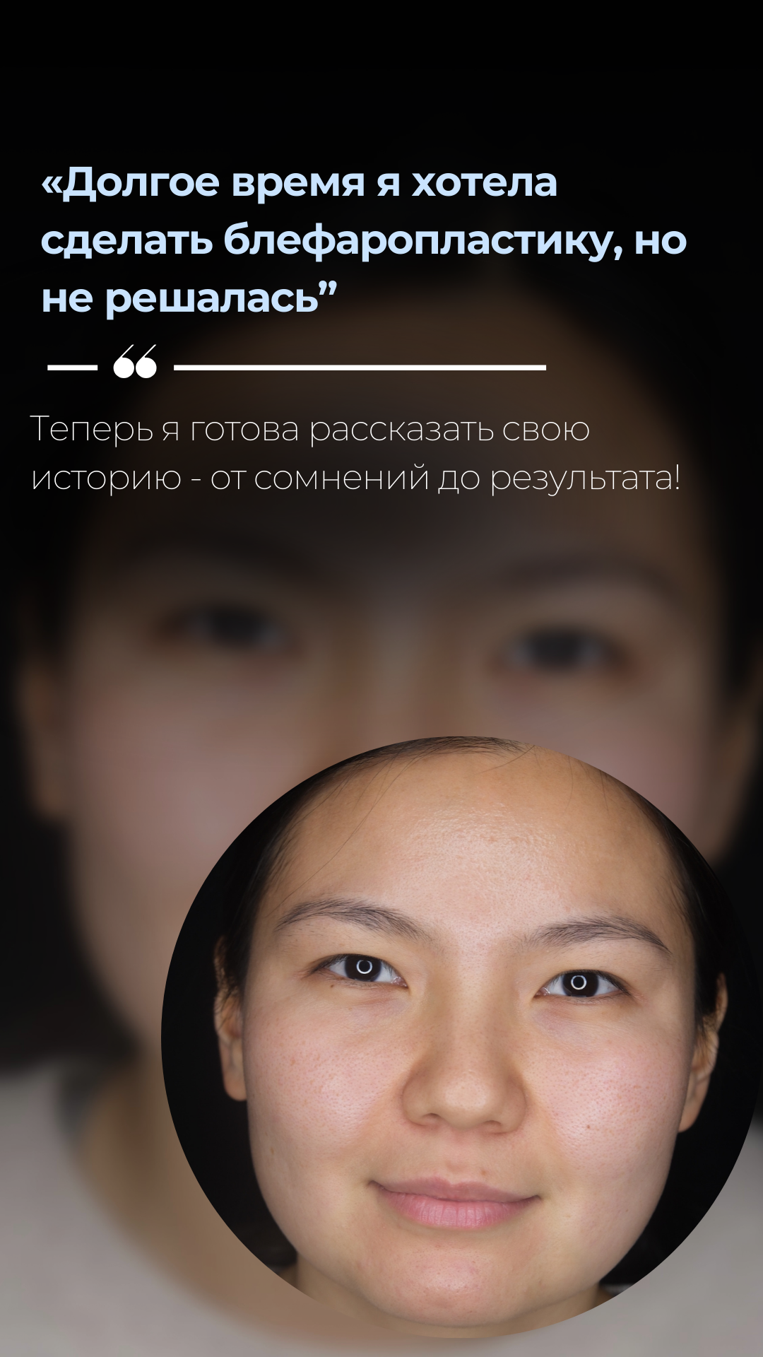 Блефаропластика 3 точки