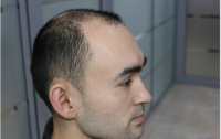 Пациент до и после пересадки