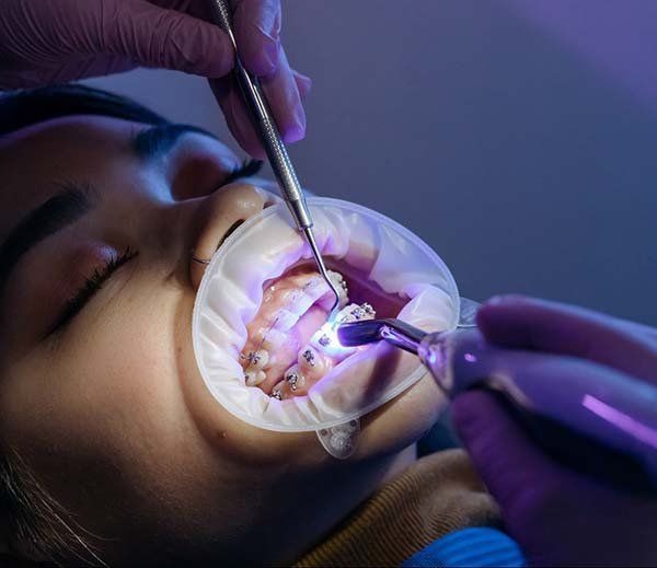 Профессиональная чистка при ношении брекетов