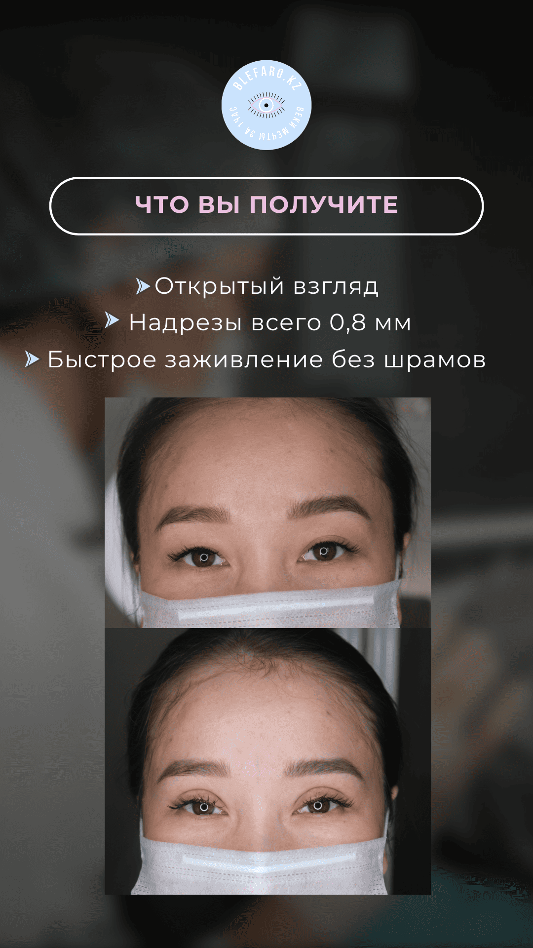 Блефаропластика 3 точки