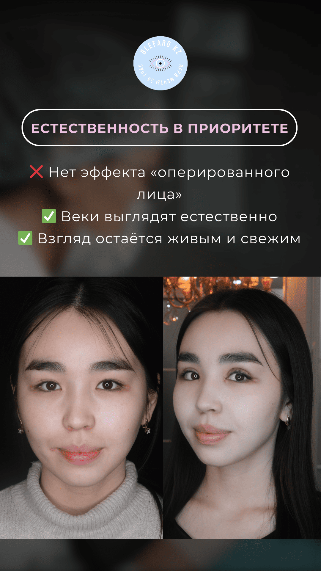 Блефаропластика 3 точки