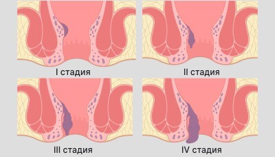 Первые Стадии Геморроя Фото