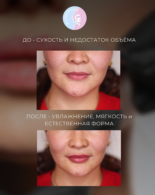 Контурная пластика филлерами алматы