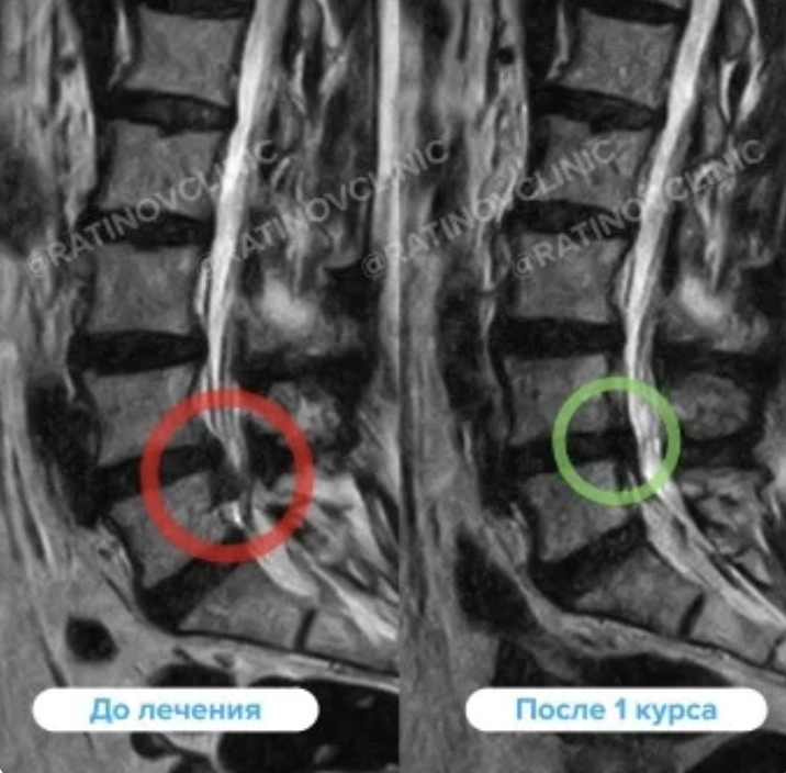 МРТ до и после лечения грыжи