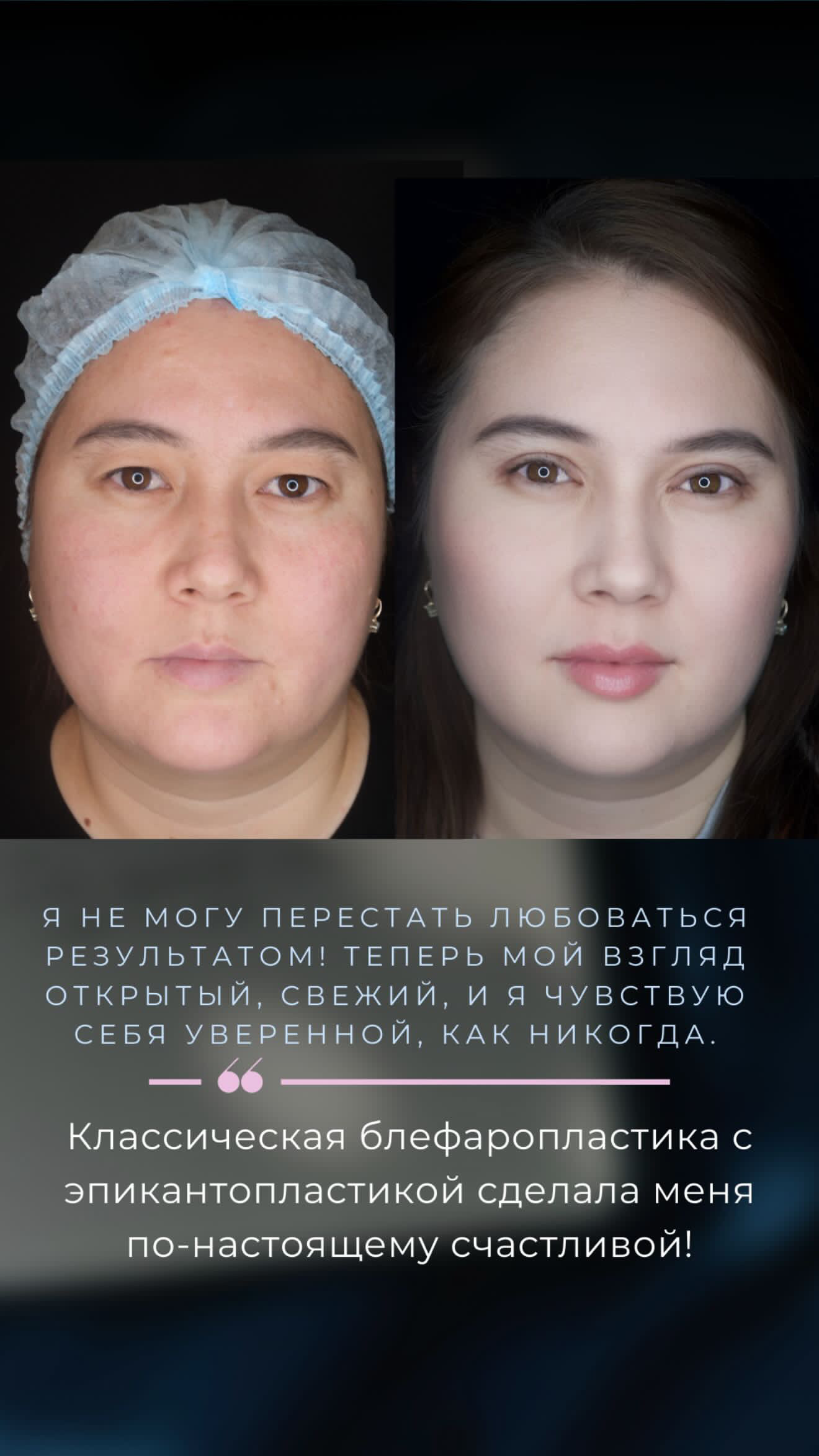 Классическая блефаропластика