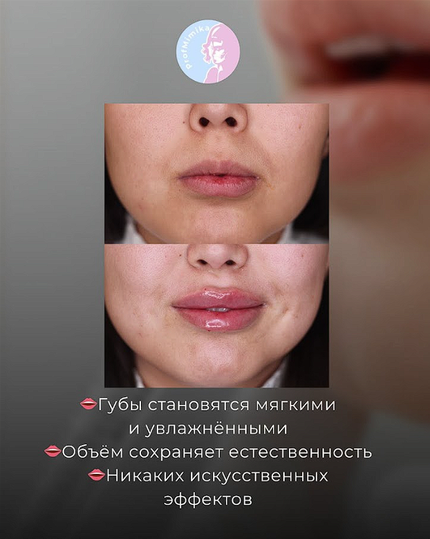Контурная пластика филлерами