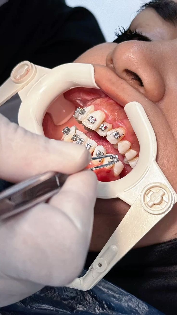 Что делать, если брекет отклеился и нет возможности сразу же попасть к ортодонту?